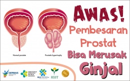 Awas Pembesaran Prostat Bisa Merusak Ginjal
