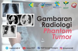 Gambaran Radiologi Phantom Tumor