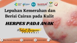 Lepuhan Kemerahan dan Berisi Cairan pada Kulit (Herpes pada Anak)