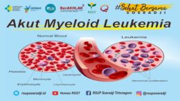Acute myeloid leukemia (AML)