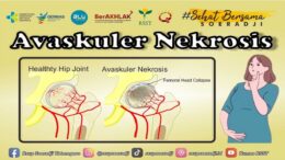 Avaskuler nekrosis
